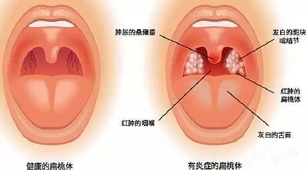 正常扁桃体与发炎扁桃体的区别