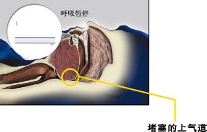 打呼噜的原理图片