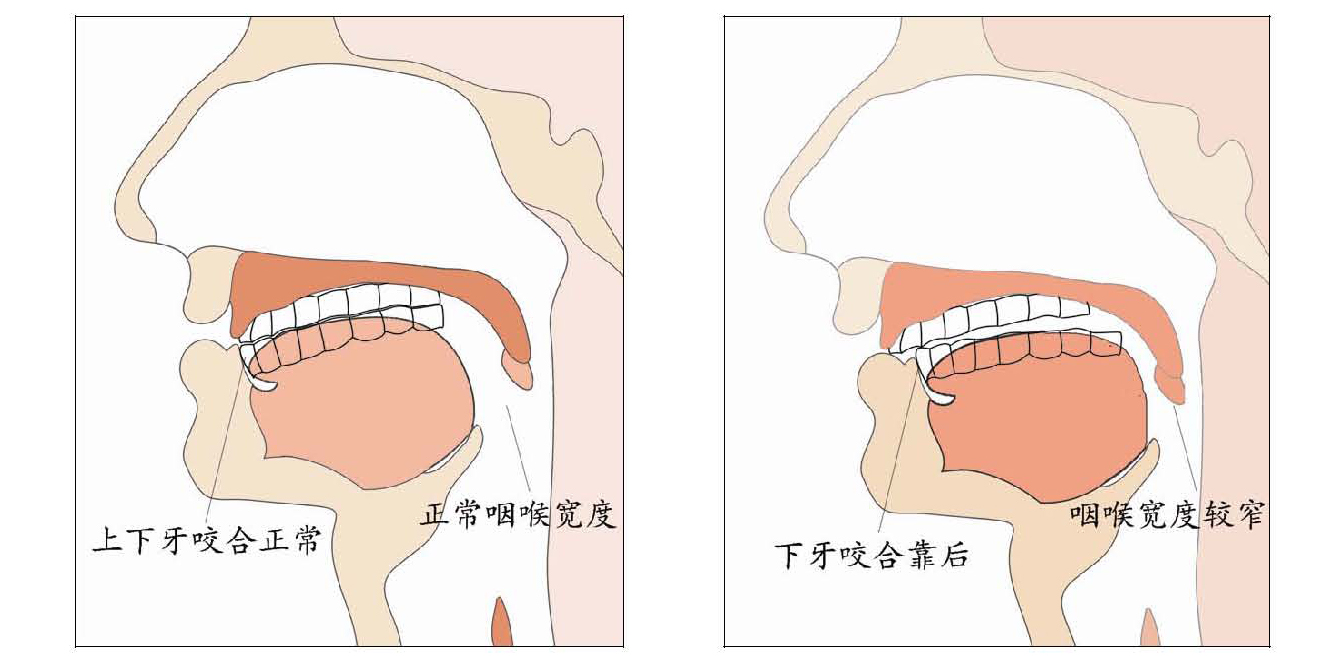 睡觉打呼噜的分析图