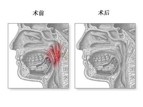 腺样体肥大治疗前后