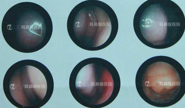 鼻内窥镜下显示图-腺样体肥大.jpg